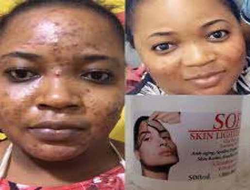 Skin Lightening/ Whitening [Bleaching]Products in South Africa +27678276964, Johannesburg -  South Africa