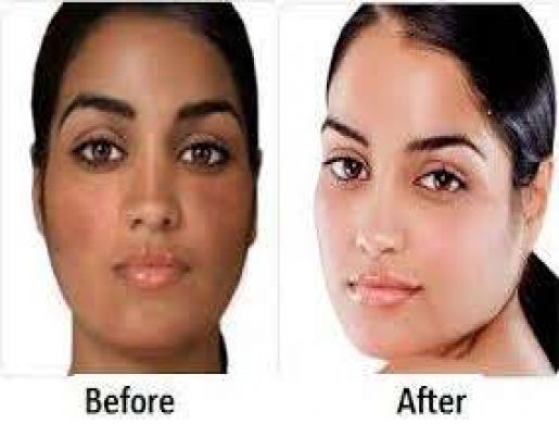 Skin Lightening/ Whitening [Bleaching]Products in South Africa +27678276964, Johannesburg -  South Africa